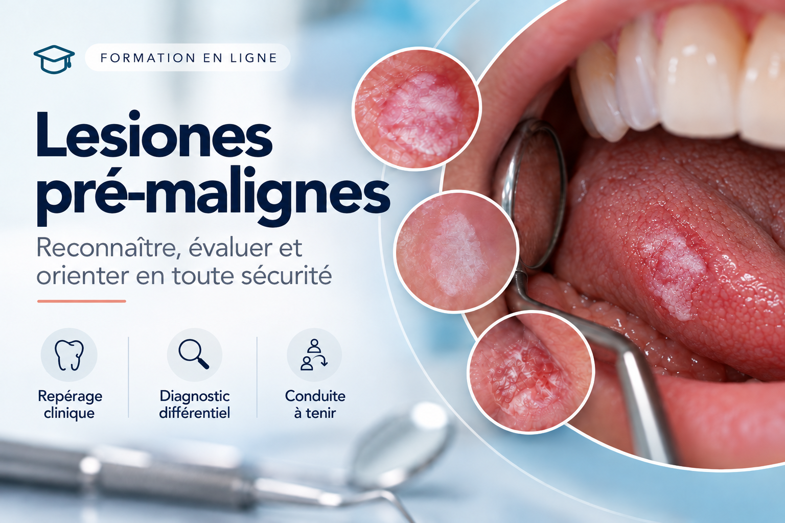Identification des lésions prémalignes dans la cavité orale